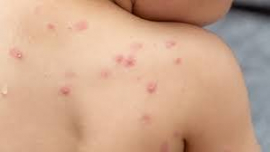 OMS declara el mpox como una emergencia mundial de salud