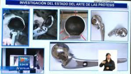 Evalúan uso de prótesis cubana parcial de cadera